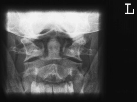 Exemplu de radiografie poziționată corect