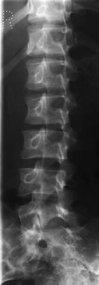 Normal stâng posterior