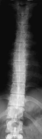 zonei și o densitate optică ridicată pe radiografie. Cordul și Silueta Cardiovasculară, precum și ficatul