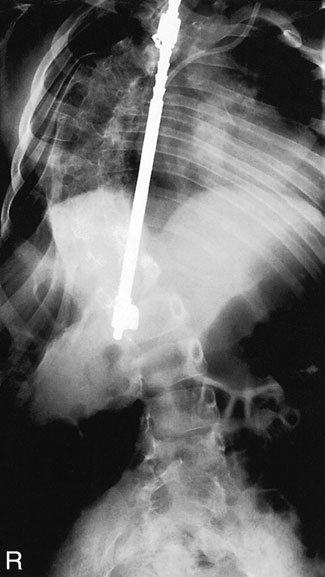 scoliosis. Affected children sunt otherwise completely normal,