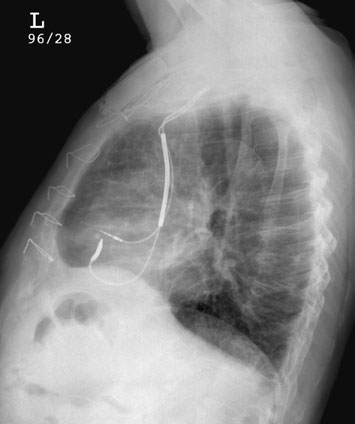• Calcificările patologice cardiace și pericardice pot fi confirmate și