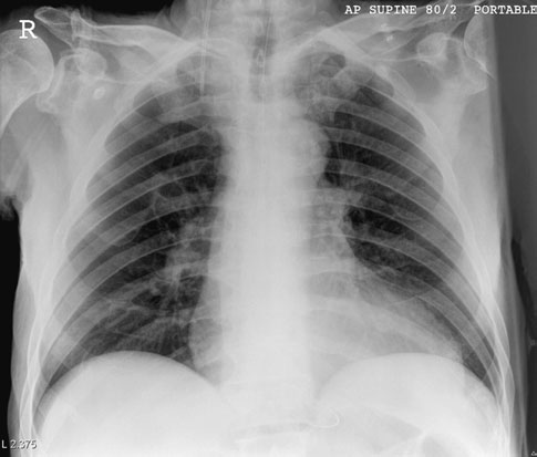 complicații precum pneumotoraxul și revărsatul pleural (pleurezia).