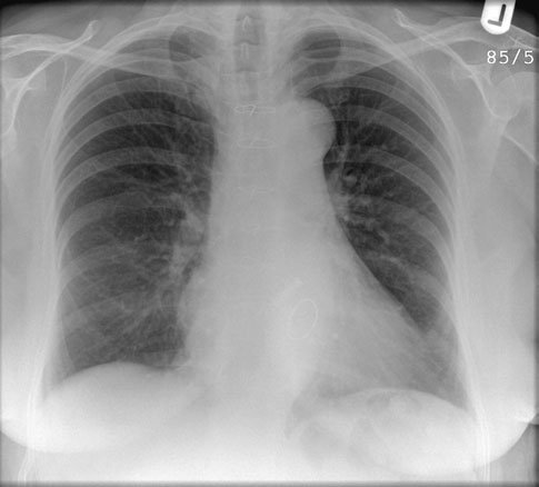 Radiografia poate ajuta la evidențierea completă a acestora. Profil