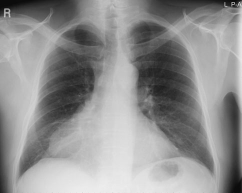 • Calcificările patologice ale valvelor native și arterelor coronare vor fi vizibile