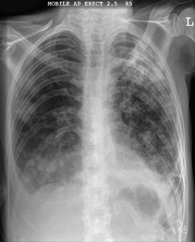monary embolus, pneumotorax și revărsat pleural (pleurezie) și pneu-