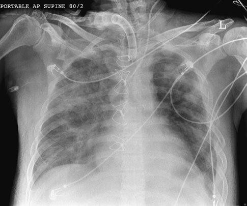 monia. Postoperative chest radiografie este also often required.