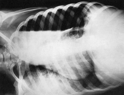 Postero-anterior (PA) radiografie în Profil (lateral) decubit poziție evidențiind pleural