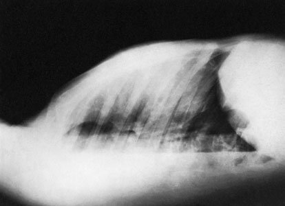 Profil (lateral) radiografie în dorsal decubit poziție evidențiind revărsat pleural (pleurezie)