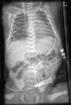 toracele și Abdomen evidențiind