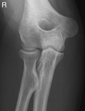 Radiografie antero-posterioară a cotului: brațul în contact cu caseta