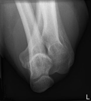 Axială radiografie de Cot – braț în plaster cast cu upper braț în
