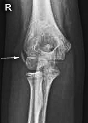 Profil (lateral) radiografie de Cot evidențiind elevation de anterior și