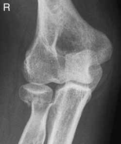 Oblică radiografii de Cot la show proximal radio-ulnar articulație