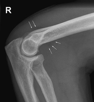 de cap radial sau supracondylar suspiciune de fractură de Humerus.