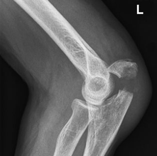 evidențiind ca slightest cortical infraction sau trabecular irreg-