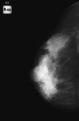 detail, e.g. micro-calcificări patologice, great care trebuie să fie taken la