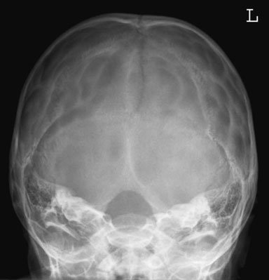 imagine de under-tilted fronto-occipital Craniu radiografie using a 15-grade pad