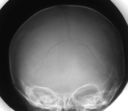Frontal diagram de Craniu evidențiind light fascicul collimation