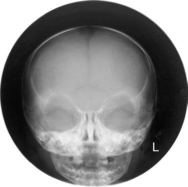 imagine de normal fronto-occipital Craniu radiografie