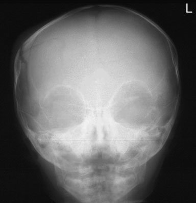 imagine de fronto-occipital Craniu radiografie de infant evidențiind drept