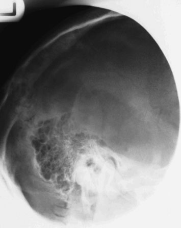 Figura 2: Aspect radiografic / Poziționare (Clark Ed. 12)