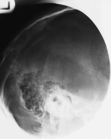 Figura 3: Aspect radiografic / Poziționare (Clark Ed. 12)