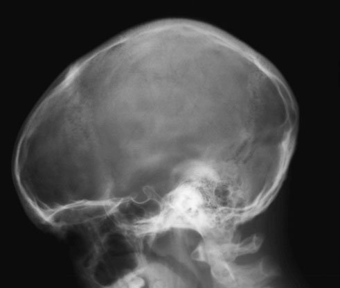 suspiciunea de fractură a bazei craniului) nu va fi vizibilă dacă pacientul este