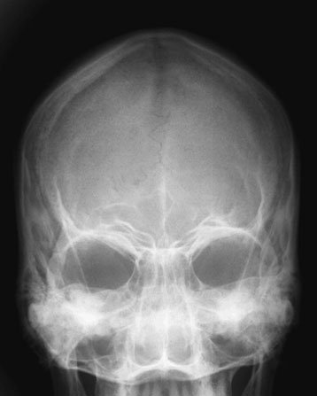 Figura 6: Aspect radiografic / Poziționare (Clark Ed. 12)