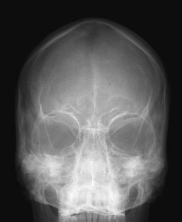 Figura 7: Aspect radiografic / Poziționare (Clark Ed. 12)