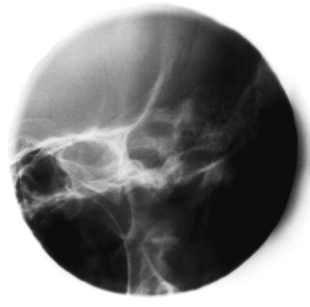 Figura 3: Aspect radiografic / Poziționare (Clark Ed. 12)