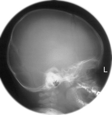 Figura 4: Aspect radiografic / Poziționare (Clark Ed. 12)