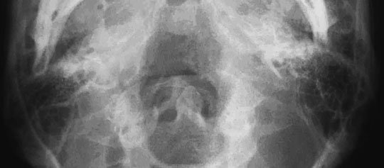 • toată anatomia inclusă pe radiografia opusă și