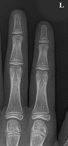 Profil (lateral) radiografie de