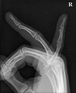 și calcificări patologice de părți moi de finger pulp.