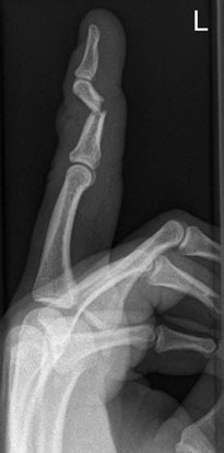 • Chip suspiciune de fractură de base de dorsal aspect de distal pha-