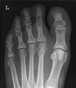 Collimated Dorso-Plantară Oblică incidență de fifth toe, evidențiind suspiciune de fractură
