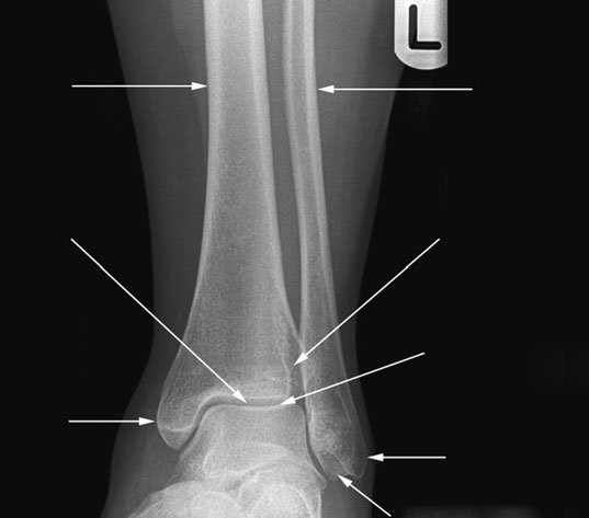 Annotated Antero-posterior (AP) radiografie