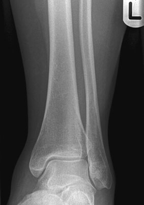 Normal Antero-posterior (AP) radiografie de