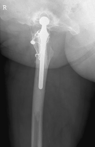 ca it poate obscure injury. în subsequent follow-up radiografii,