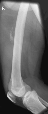 Profil (lateral) radiografie de Femur, Șold down,