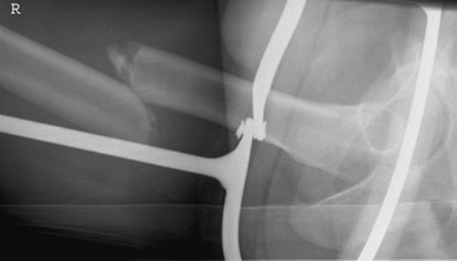 Profil (lateral) radiografie de Femur,