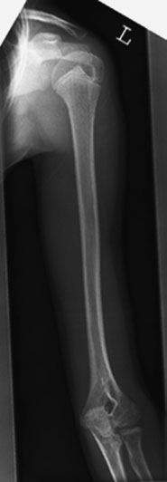 radiografie de Humerus