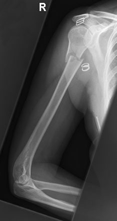 de Humerus evidențiind a