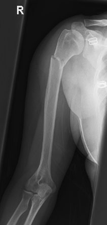 suspiciune de fractură de proximal shaft