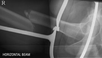 Profil (lateral) imagine de drept Fractură Femur în Thomas’s splint