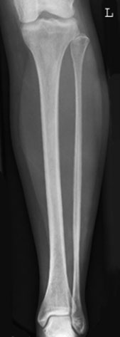 suspiciune de fractură de distal fibula.