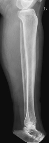 radiografie evidențiind