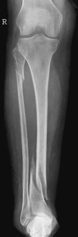 suspiciune de fractură de proximal