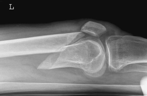 gross injury și suspected suspiciune de fractură de Rotulă (Patelă).