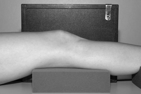 patellar suspiciune de fractură being separated prin opposing muscle pull.